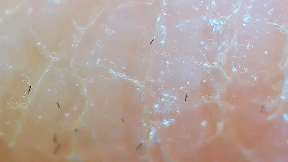 cf in skin