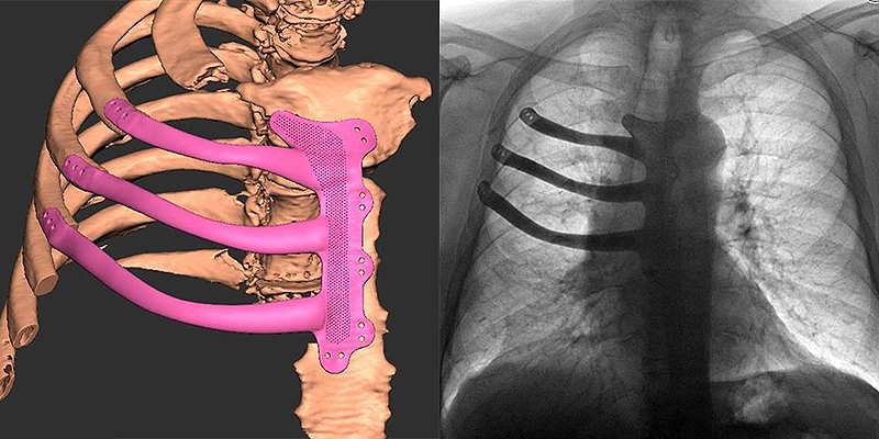 3d printed chest prosthesis 02